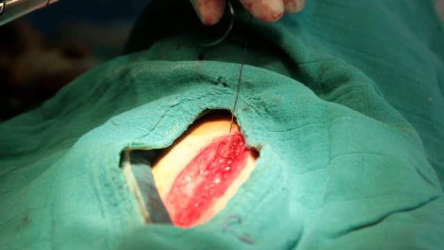 finir la suture interne