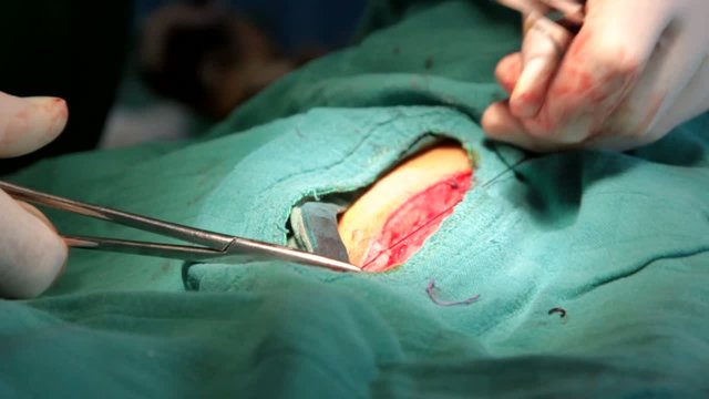 commencer les sutures externes