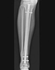 radio fracture de jambe enclouage