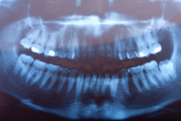 dental x-ray