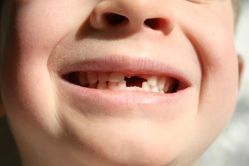 Zahnlücke bei einem kleinen Kind 