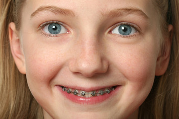 Dental Braces