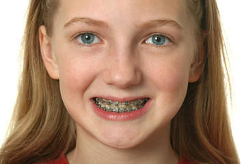 Fototapeta premium Dental Braces