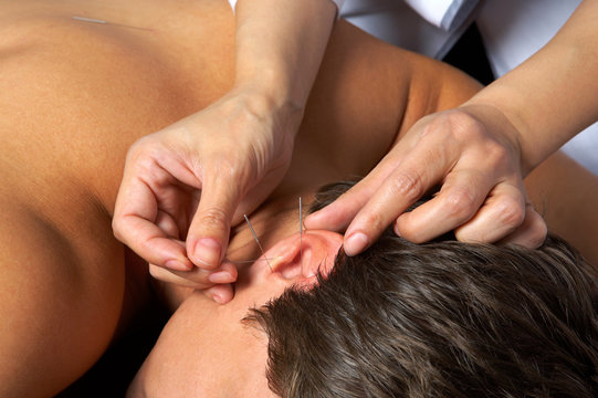 acupuncture of  ear