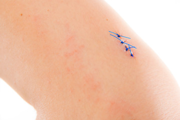 stiched up injury