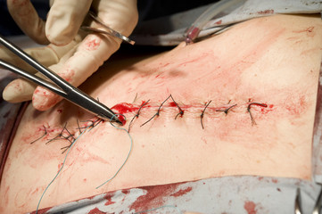 Needle holder in hands of surgeon