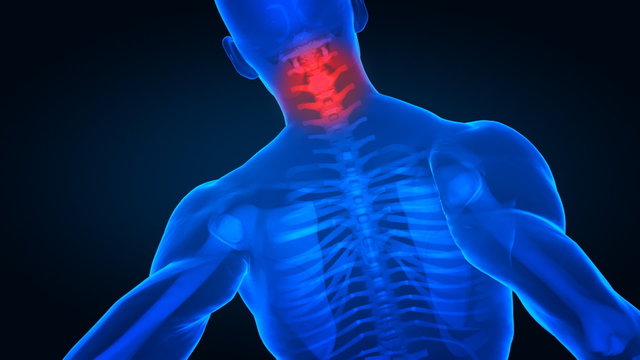 Cervical spine cincept - painful neck x-ray