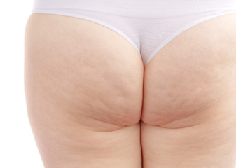 Cellulite