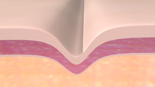 Skin Fold