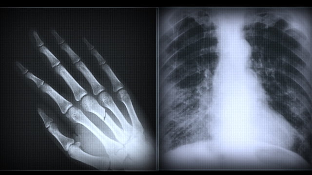 x-ray