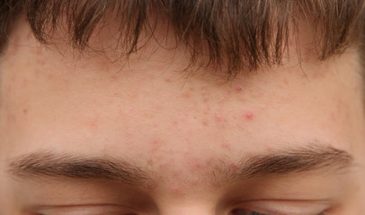 acne forehead