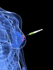 Injektion - Biopsie