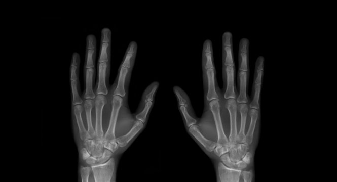 X-Ray of Hands