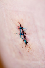 Stitches Detail