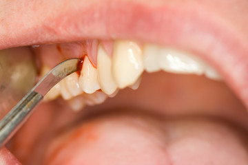 dental treatment
