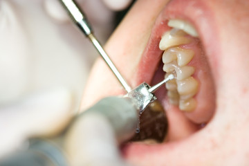 dental treatment