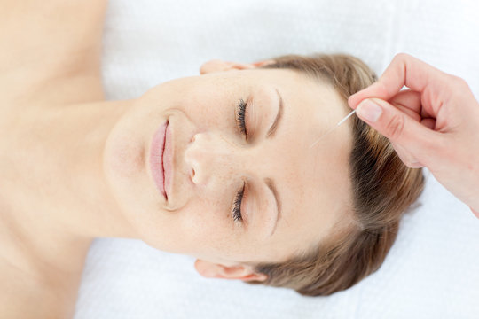 Acupuncture Needles On A Relaxed Woman's Head