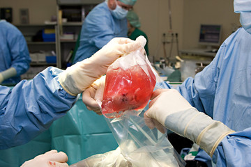 Nierentransplantation34