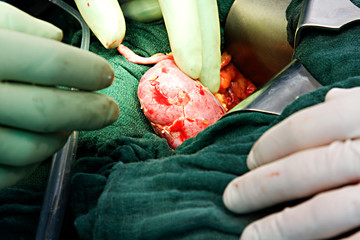Nierentransplantation11