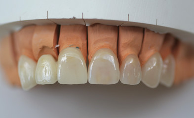 Brücke und Veneers