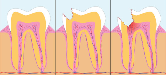 Three phase of caries, vector illustration