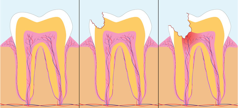Three phase of caries, vector illustration