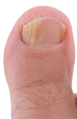 Right foot toe nail suffering from fungus infection.