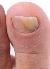 Fototapeta premium Left foot toe nail suffering from fungus infection.