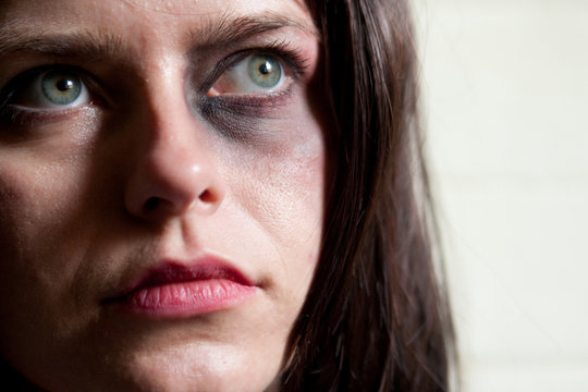 Close-up of beautiful woman with black-eye