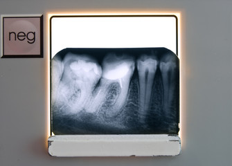 X-ray teeth diagnostics