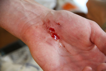 Handverletzung