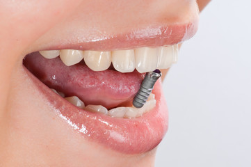 Geöffneter Mund mit Implantat