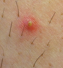 ingrown hair