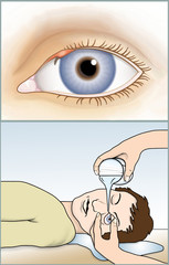 Erste Hilfe bei Fremdkoerper im Auge