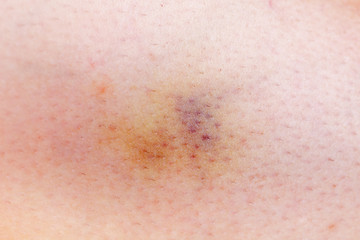 bruised woman skin