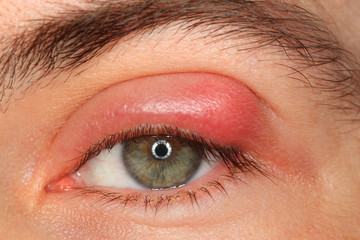 illness person eye with sty and pus looking into camera
