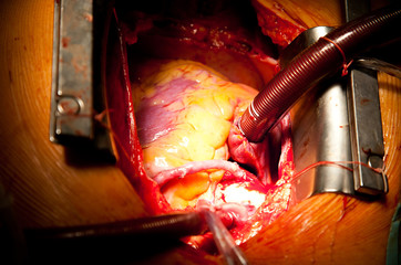 coronary artery bypass grafting - obrazy, fototapety, plakaty