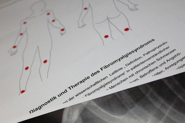 Fibromyalgiesyndrom