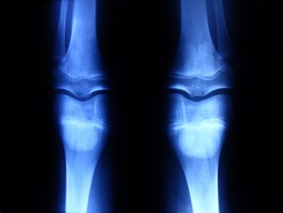 X-ray picture showing knee joints