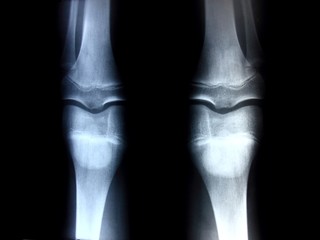 X-ray picture showing knee joints