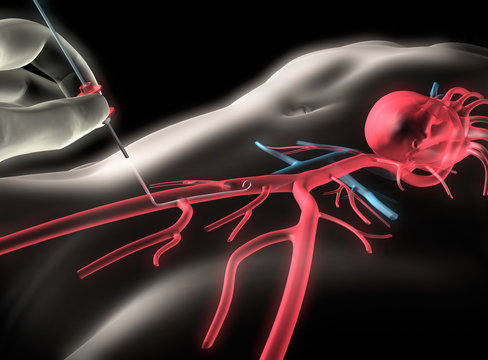 Herzkatheter - Einf&uuml;hren in die Aterie 1