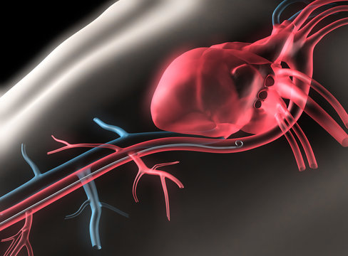 Herzkatheter - Weg in der Aterie