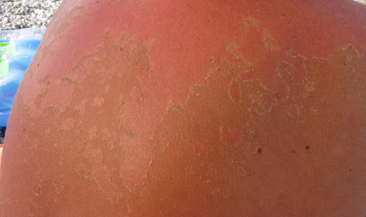 Fototapeta premium sunburn