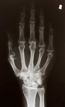 X-ray picture of right hand