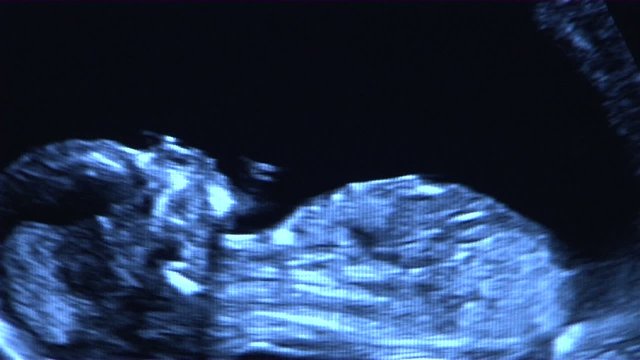 Ultraschallbild Kind