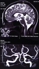 X-ray image of the brain