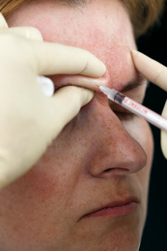 Botox injection in the superciliary arch, close up