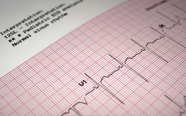 Pediatric electrocardiogram.