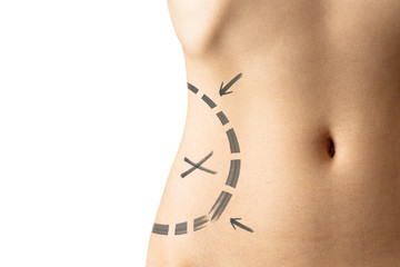 Female waistline about to perform liposuction - obrazy, fototapety, plakaty
