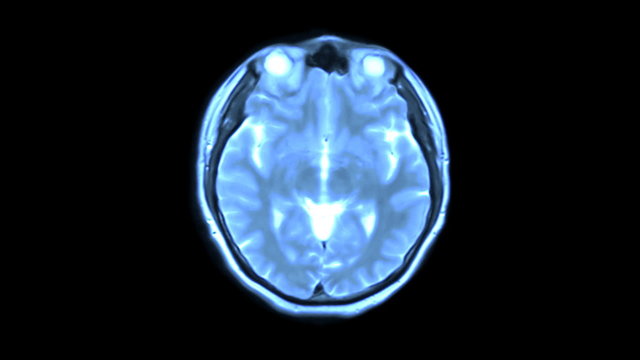 MRI brain scan